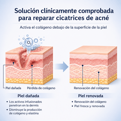 Microinfusión para el Cuidado de la Piel, Reduce las cicatrices del acné, mejora la textura de la piel