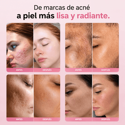 Microinfusión para el Cuidado de la Piel, Reduce las cicatrices del acné, mejora la textura de la piel